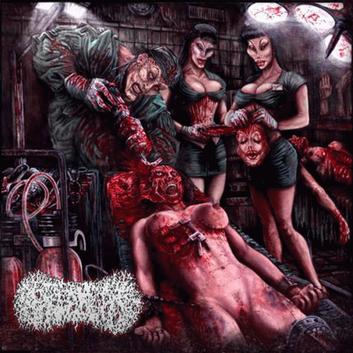 Surgical Excoriation.